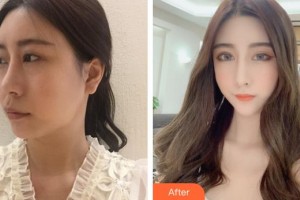 安徽韓美整形美容醫(yī)院李瑞整形價(jià)格表附[美鼻+媚眼]鼻眼部手術(shù)案例展示