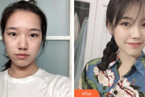 安徽韓美整形美容醫(yī)院吳金平整形價(jià)格表附疤痕案例展示