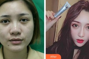 安徽醫(yī)科大學(xué)附屬巢湖醫(yī)院燒傷整形科劉安軍整形價(jià)格表附鼻部綜合案例展示