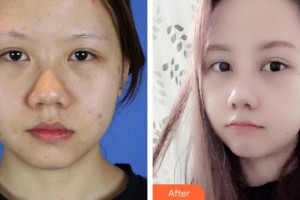 安徽醫(yī)科大學(xué)附屬巢湖醫(yī)院燒傷整形科葛禮正整形價(jià)格表附鼻部整形案例展示