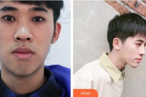 安徽維納斯醫(yī)院整形外科刑志平整形價(jià)格表附鼻部手術(shù)案例展示