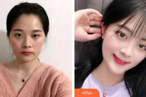 安徽維納斯醫(yī)院整形外科陳棟整形價(jià)格表附埋線提升案例展示