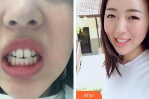 安徽天鵝湖口腔醫(yī)院丁杉整形價(jià)格表附牙齒矯正案例展示