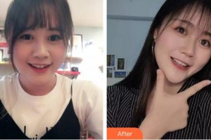 安徽天鵝湖口腔醫(yī)院周健整形價(jià)格表附牙齒不整齊牙齒擁擠 案例名稱	案例展示