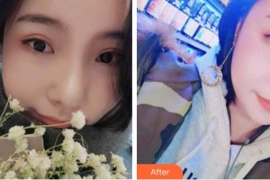 安徽天鵝湖口腔醫(yī)院閆勇整形價(jià)格表附牙齒矯正案例展示