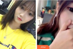 安徽天鵝湖口腔醫(yī)院彭國新整形價(jià)格表附牙綜合案例展示