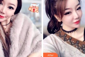 安徽天鵝湖口腔醫(yī)院吳翔整形價(jià)格表附牙齒隱形矯正案例展示