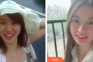 安徽天鵝湖口腔醫(yī)院吳小月整形價(jià)格表附牙齒矯正案例展示