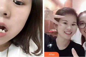 安徽天鵝湖口腔醫(yī)院婁雙岳整形價(jià)格表附牙齒陶瓷矯正案例展示