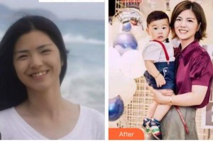 安徽天鵝湖口腔醫(yī)院張鵬整形價(jià)格表附牙齒矯正案例展示