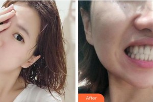 安徽醫(yī)科大學(xué)口腔醫(yī)學(xué)院王海林整形價(jià)格表附隱形托槽矯正案例展示