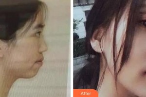 安徽醫(yī)科大學(xué)口腔醫(yī)學(xué)院徐文華整形價(jià)格表附金屬托槽矯正案例展示