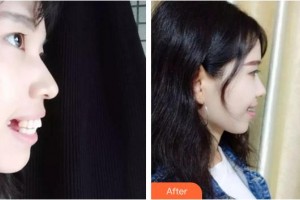 安徽醫(yī)科大學(xué)口腔醫(yī)學(xué)院何家才整形價(jià)格表附齙牙小仙女案例展示