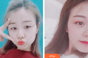 廣州美詩沁醫(yī)療美容門診部徐文奎整形價格表附雙眼皮案例展示