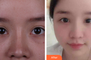 廣州締妍醫(yī)療美容門診部李應(yīng)整形價格表附眼部整形案例展示