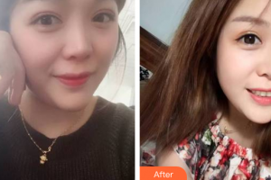 廣州拜博醫(yī)療美容門診部李正衍整形價格表附牙齒隱形矯正案例展示