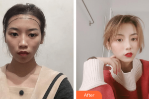 廣州弘基醫(yī)療美容門診部廖莉整形價格表附植發(fā)案例展示