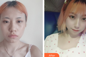 廣州博研醫(yī)療美容門診部陳勇軍整形價格表附凹陷疤痕案例展示