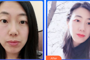 廣州美詩沁醫(yī)療美容門診部霍建法整形價格表附眼部整形案例展示