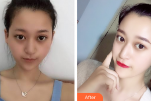 廣州弘基醫(yī)療美容門診部崔浩鉉整形價格表附顴骨降低案例展示