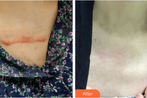 廣州凱美達整形美容醫(yī)院曾芬整形價格表附微創(chuàng)疤痕修復(fù)案例展示