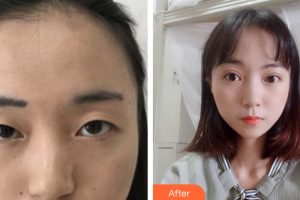 廣州美詩沁醫(yī)療美容門診部薄曉茹整形價格表附眼部手術(shù)案例展示