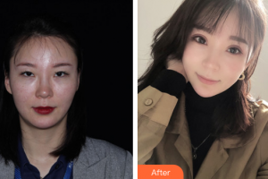 民航廣州醫(yī)院整形美容科陳小光整形價格表附眼部綜合案例展示