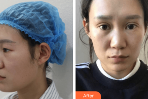 廣州軍美整形醫(yī)院產(chǎn)慎之整形價格表附雙眼皮案例展示