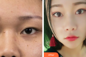 廣州美詩沁醫(yī)療美容門診部宣瑞軍整形價格表附眼部手術(shù)案例展示