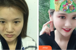 廣州博研醫(yī)療美容門診部劉仲榮整形價格表附微創(chuàng)疤痕修復(fù)案例展示