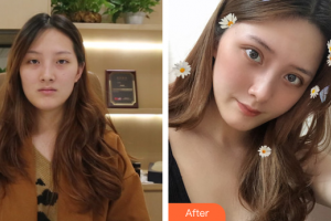 廣州美詩沁醫(yī)療美容門診部王連梅整形價格表附切開雙眼皮案例展示