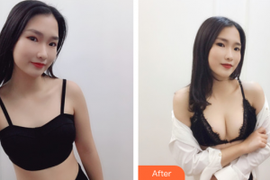 廣州塑妍醫(yī)療美容門診部黎明整形價(jià)格表附自體脂肪隆胸案例展示