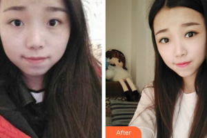 廣州懿美秀醫(yī)療美容門診部彭雷整形價(jià)格表附眼部手術(shù)案例展示