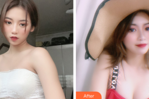 廣州懿美秀醫(yī)療美容門診部劉波整形價(jià)格表附自體脂肪隆胸案例展示