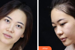 廣州懿美秀醫(yī)療美容門診部羅輝整形價(jià)格表附眼部整形案例展示