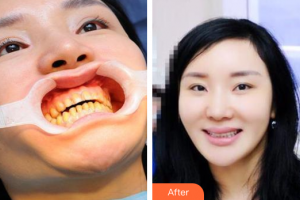 廣州雅度口腔門診部王大為整形價(jià)格表附瓷貼面案例展示