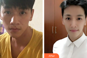 廣州鵬愛醫(yī)療美容門診部黃文亭整形價(jià)格表附鼻部手術(shù)案例展示