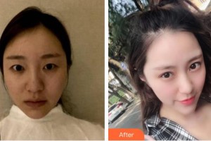 合肥伊爾醫(yī)療美容診所閆品行整形價(jià)格表附眼部綜合案例展示