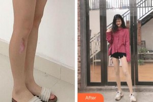 合肥恒美整形醫(yī)院周鐵政整形價(jià)格表附增生疤痕案例展示