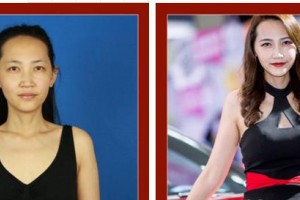 合肥恒美整形醫(yī)院錢毅整形價(jià)格表附假體隆胸案例展示