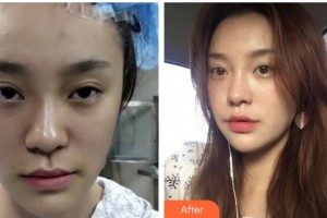 合肥凱美醫(yī)療美容醫(yī)院秦宏智整形價(jià)格表附埋線提升案例展示