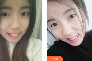 合肥麗人女子醫(yī)院中韓整形美容中心尹杜龍整形價(jià)格表附口腔矯正案例展示