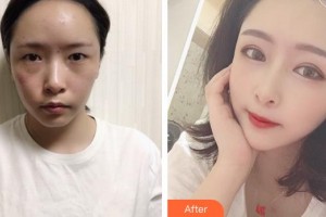 合肥恒美整形醫(yī)院汪信泮整形價(jià)格表附雙眼皮案例展示