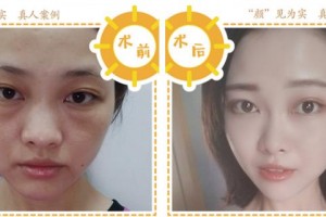 合肥伊爾醫(yī)療美容診所楊乂整形價(jià)格表附埋線提升案例展示