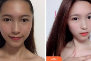 合肥華美整形美容醫(yī)院郭峰整形價(jià)格表附眼部綜合案例展示