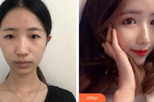 合肥艾雅整形美容醫(yī)院富秋濤整形價(jià)格表附眼部案例展示