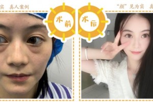 合肥華美整形美容醫(yī)院秦興利整形價(jià)格表附埋線提升案例展示