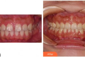 合肥麗人女子醫(yī)院中韓整形美容中心魏華生整形價(jià)格表附牙齒正畸案例展示