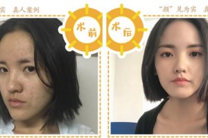 合肥天鵝湖整形美容醫(yī)院葉麗琴整形價(jià)格表附埋線提升案例展示