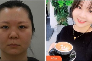 合肥華美整形美容醫(yī)院鄭盛謨整形價(jià)格表附多方面部埋線提升案例展示